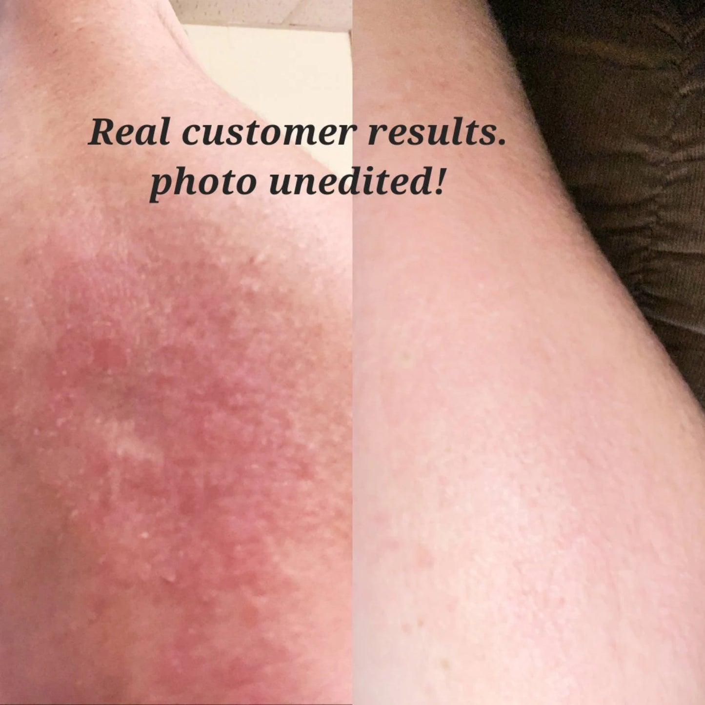 Eczema Cream | Dry Skin Cream |